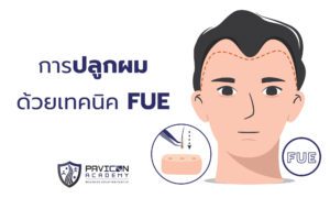 FUE Hair Transplant Pavicon Mediness Center