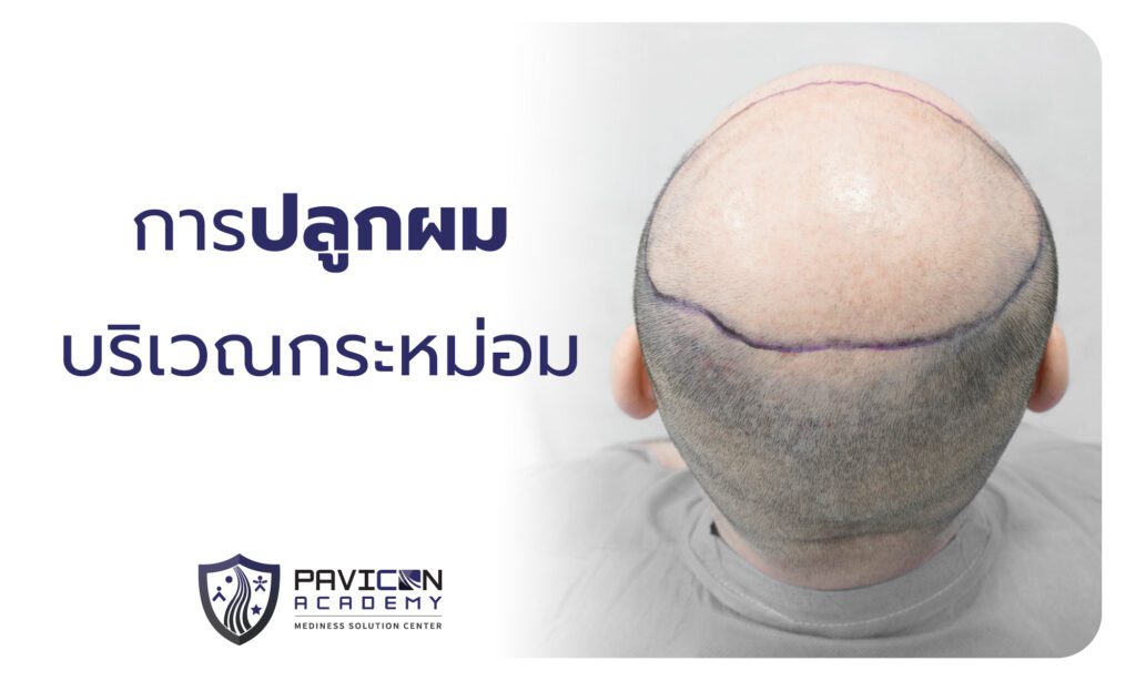 Crown Hair Transplant - Pavicon Mediness Center