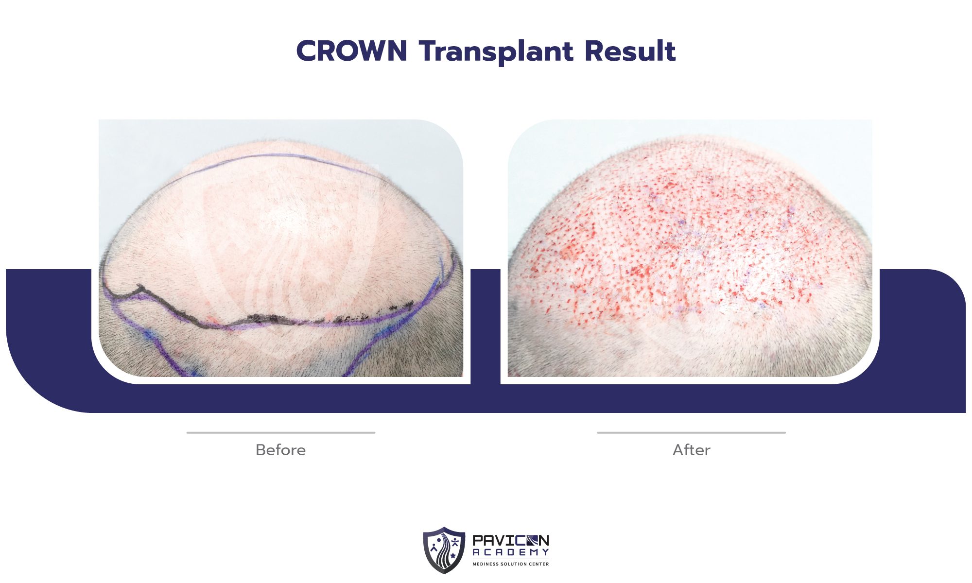 Crown Hair Transplant - Pavicon Mediness Center