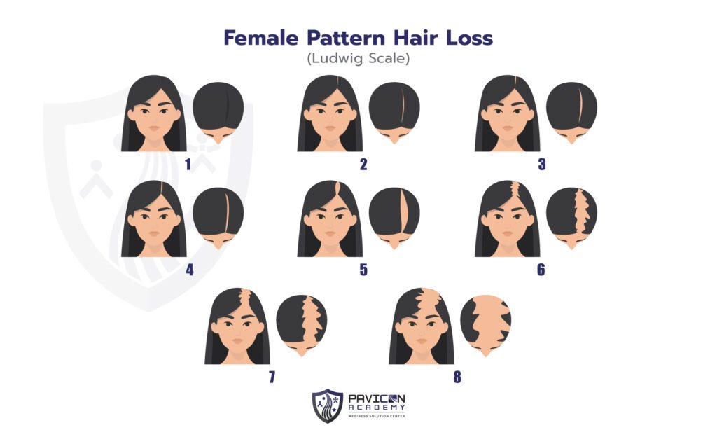 https://pavicon.com/wp-content/uploads/2021/09/Hair-Transplant-in-WOMAN-EN-02-1024x614.jpg