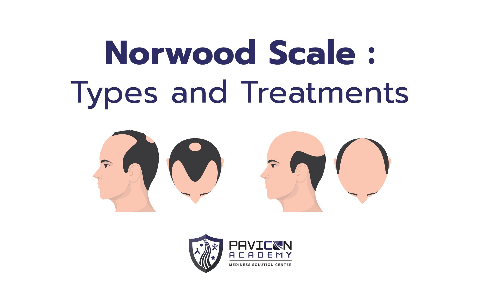 Norwood And Hamilton Scales Pavicon Mediness Center 4635