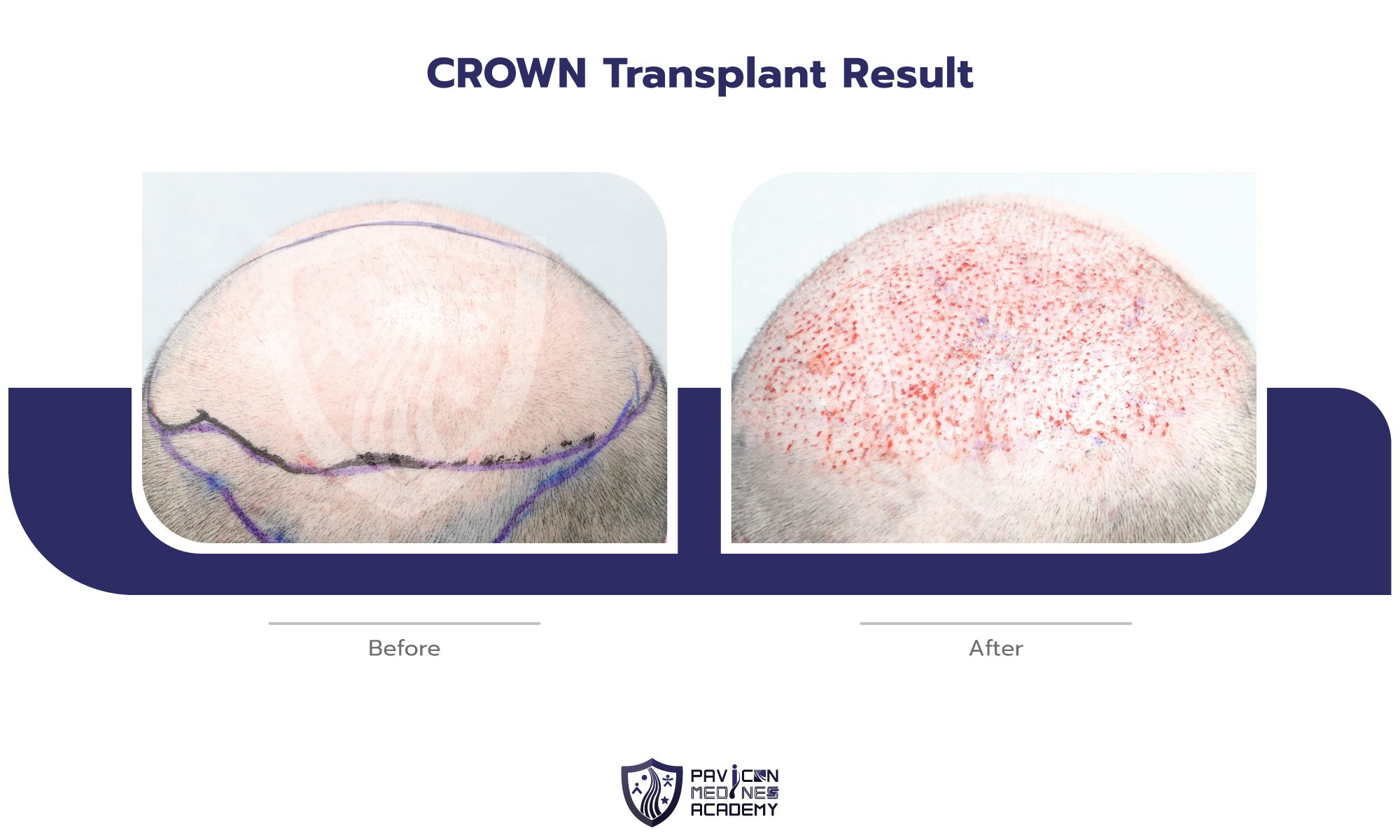 CROWN-Hair-Transplant-EN-05