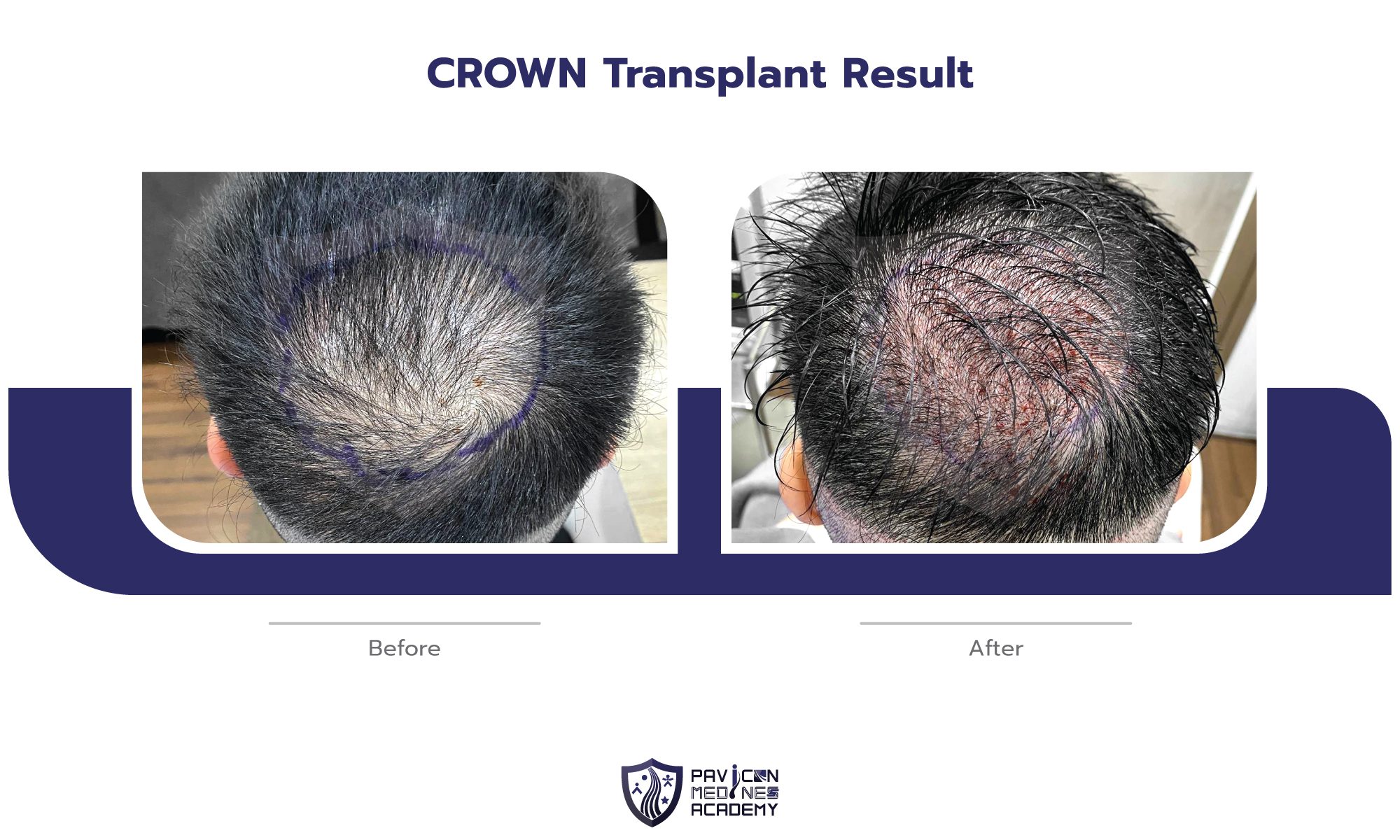 Crown Hair Transplant - Pavicon Mediness Center