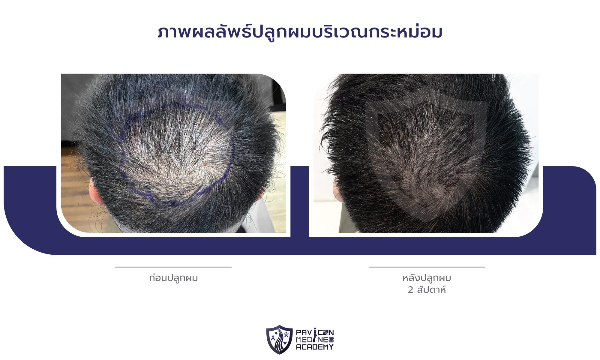 CROWN-Hair-Transplant-TH-BA-03