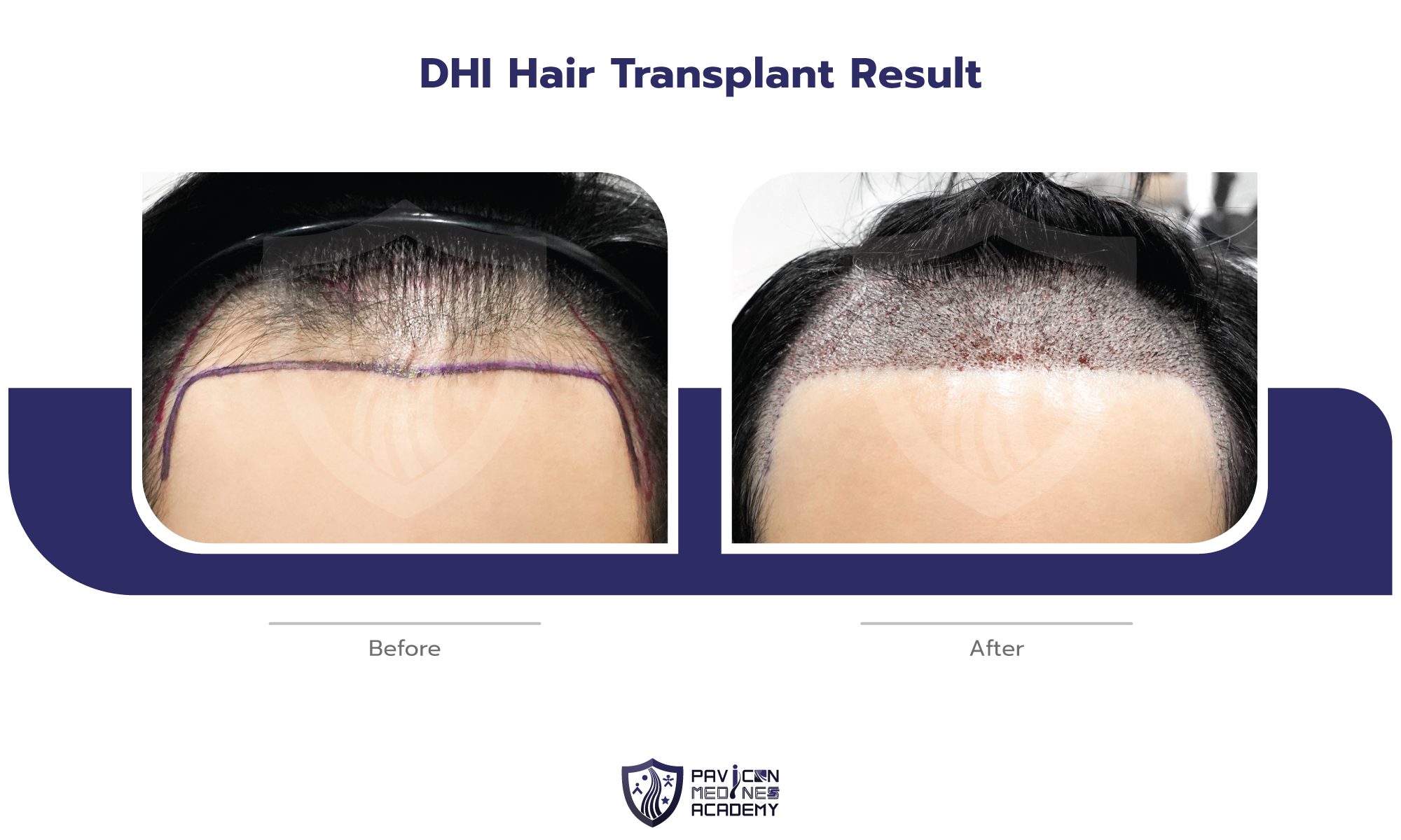DHI-Hair-Transplant-EN-04