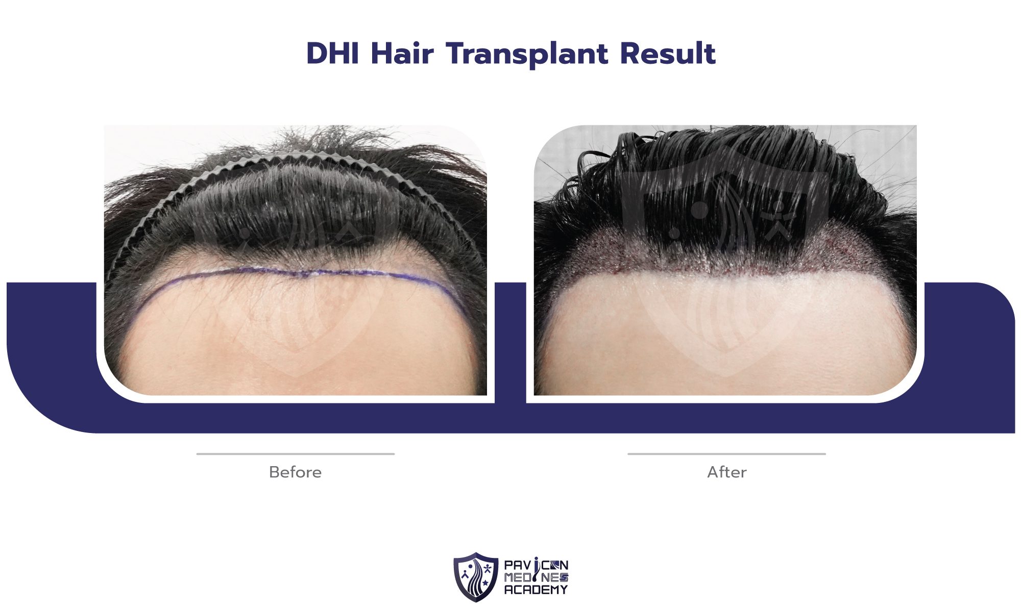 DHI-Hair-Transplant-EN-07
