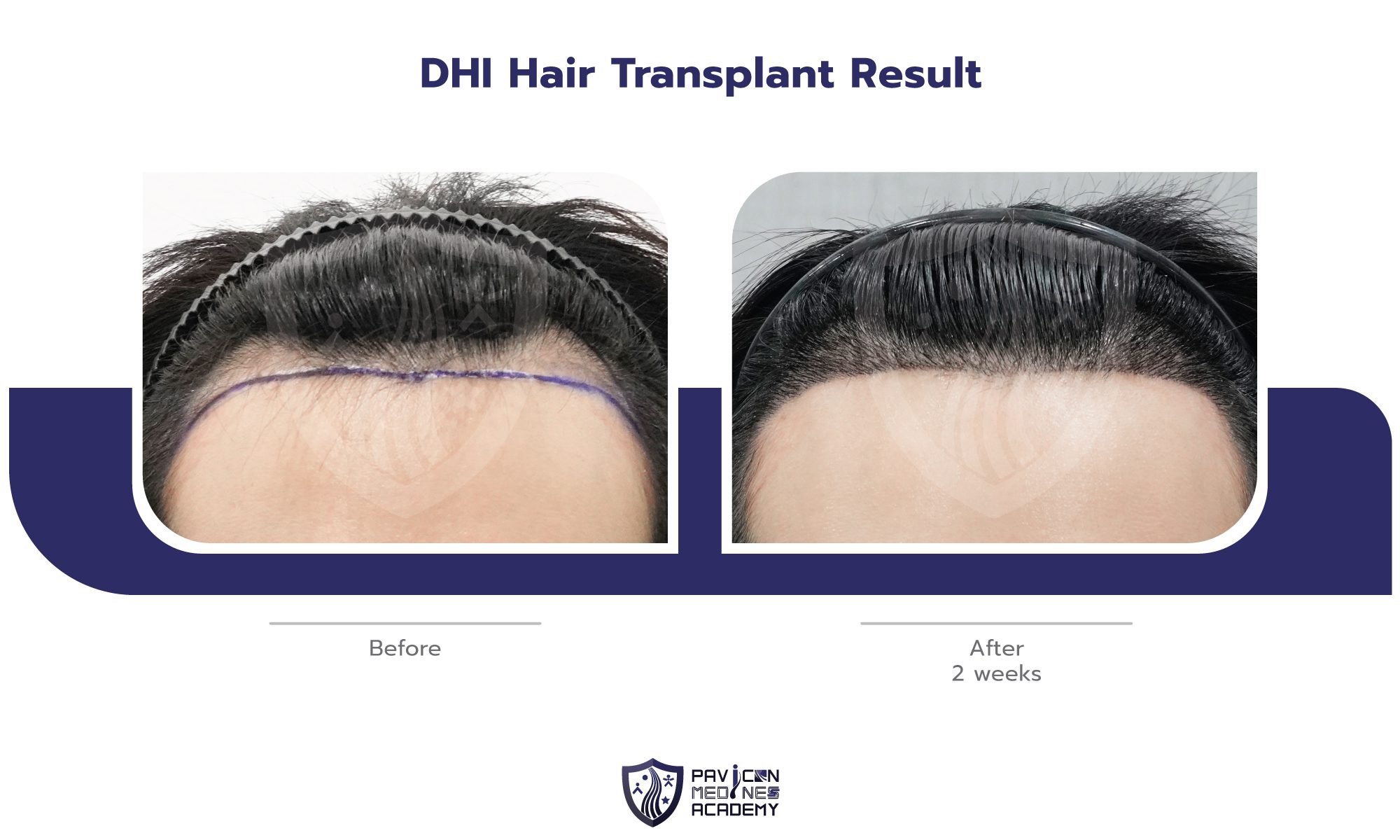 DHI-Hair-Transplant-EN-08