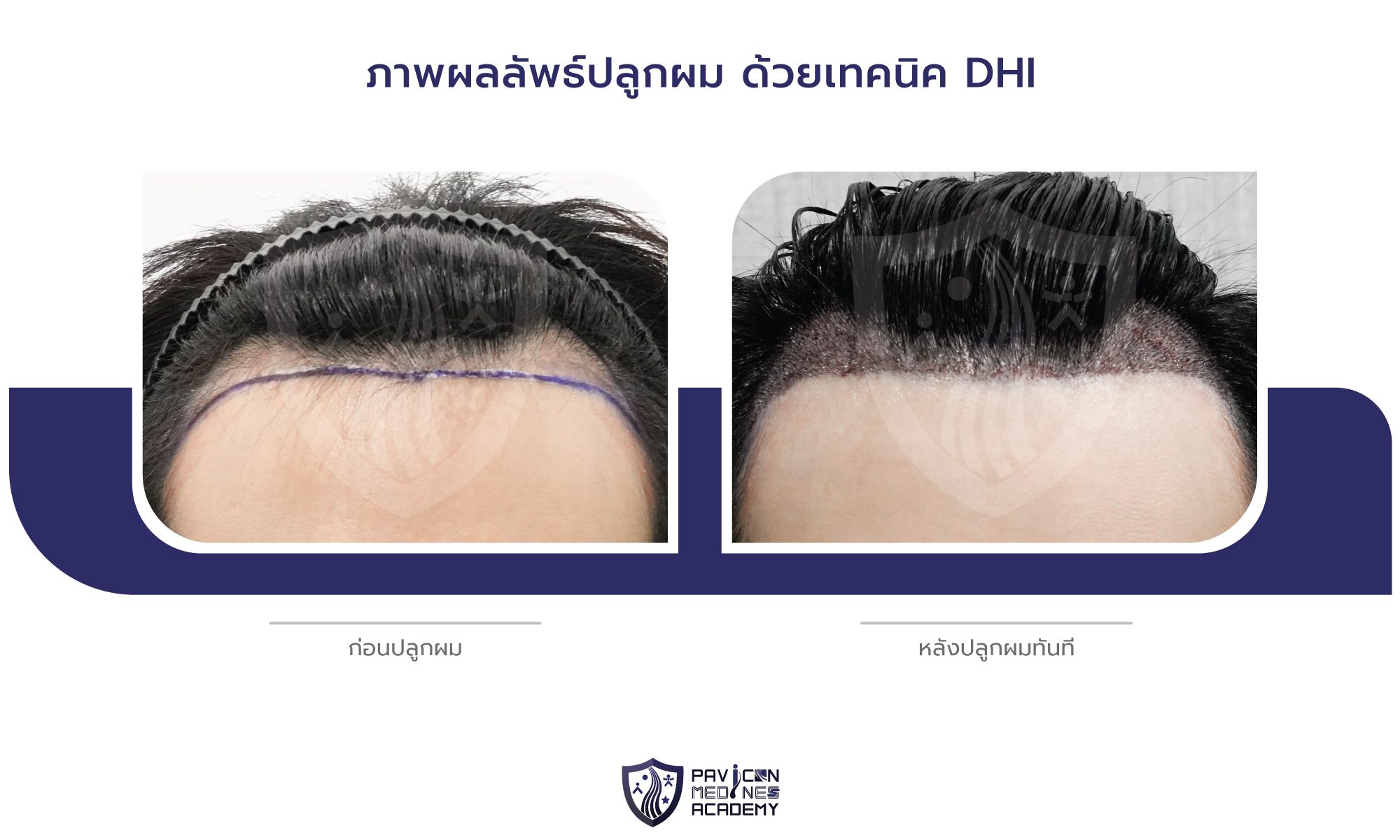 DHI-Hair-Transplant-TH-BA-04