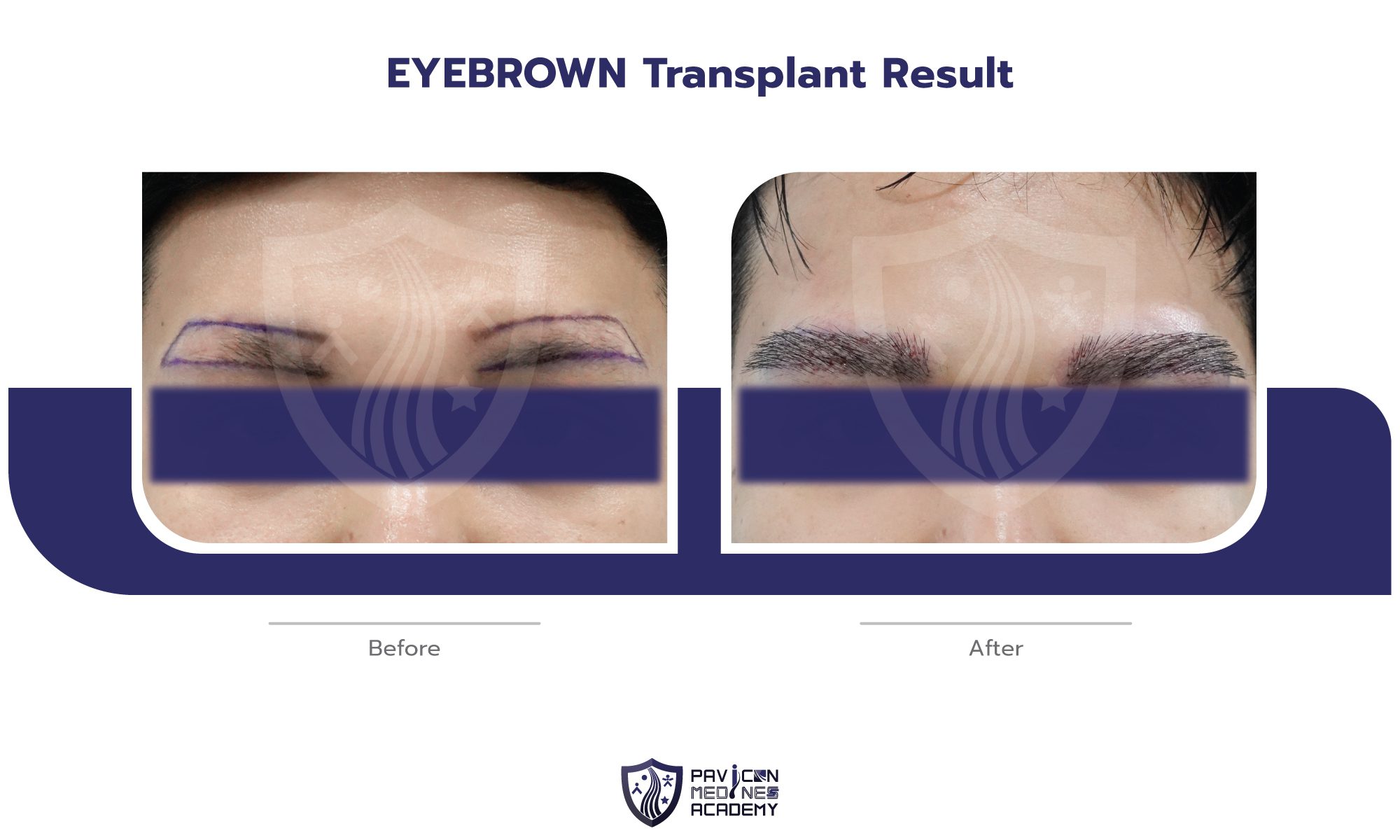 EYEBROW-Hair-Transplant-EN-02