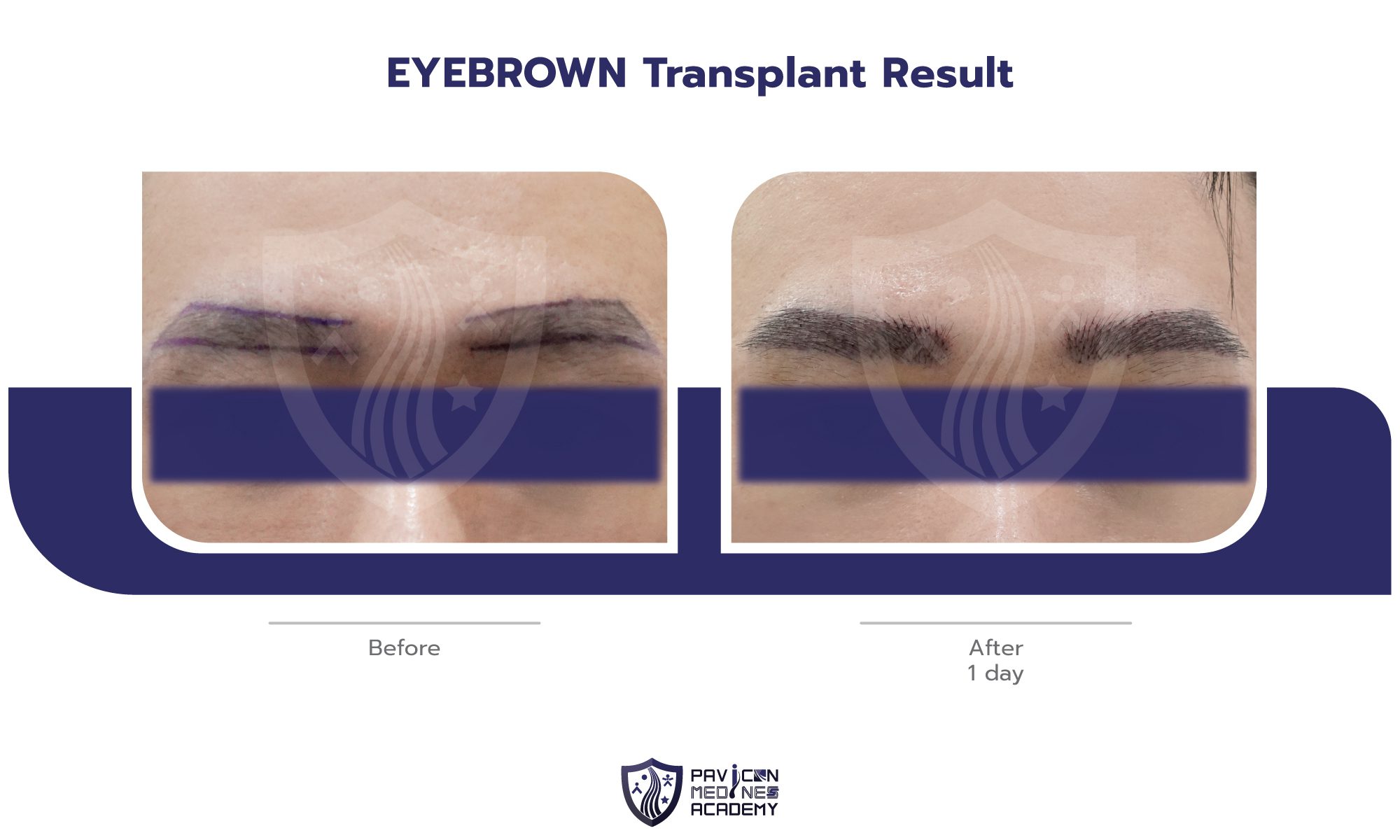 EYEBROW-Hair-Transplant-EN-03
