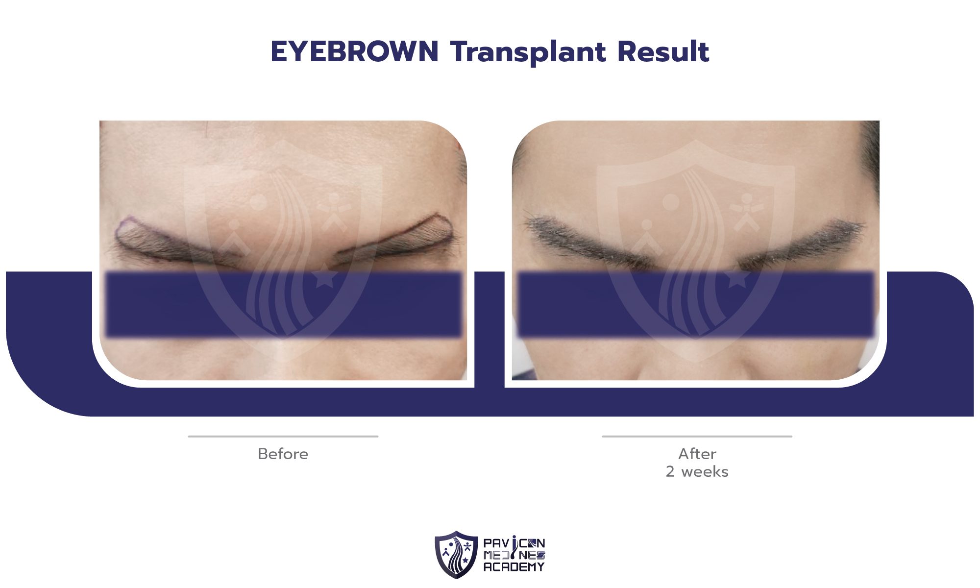 EYEBROW-Hair-Transplant-EN-04