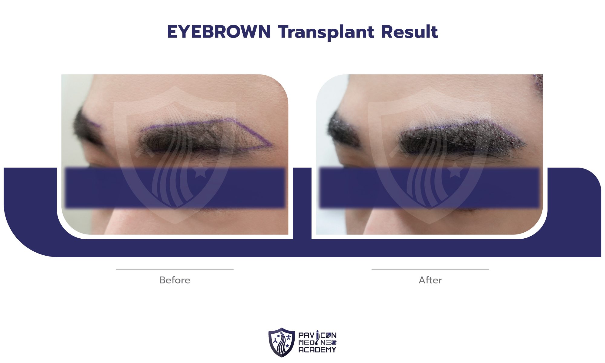 EYEBROW-Hair-Transplant-EN-05