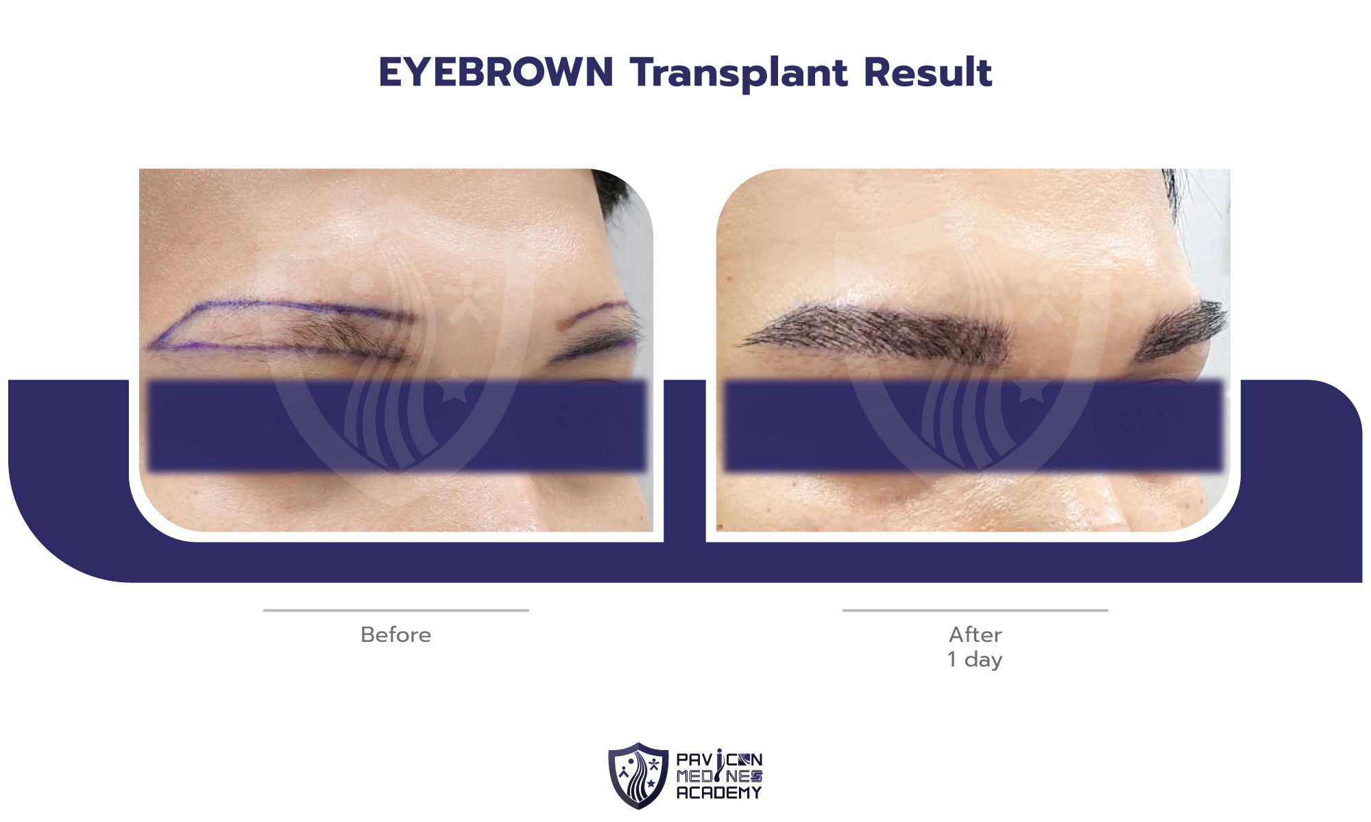 EYEBROW-Hair-Transplant-EN-06