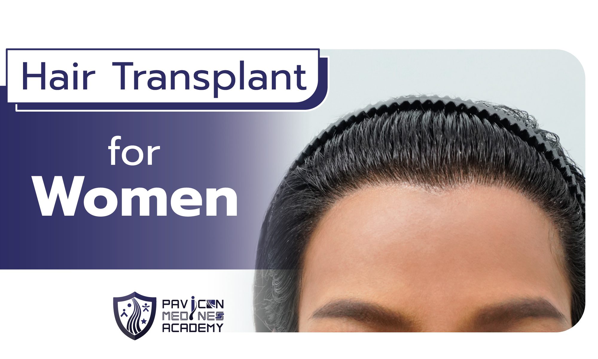 Hair Transplantation for Women - Pavicon Mediness Center