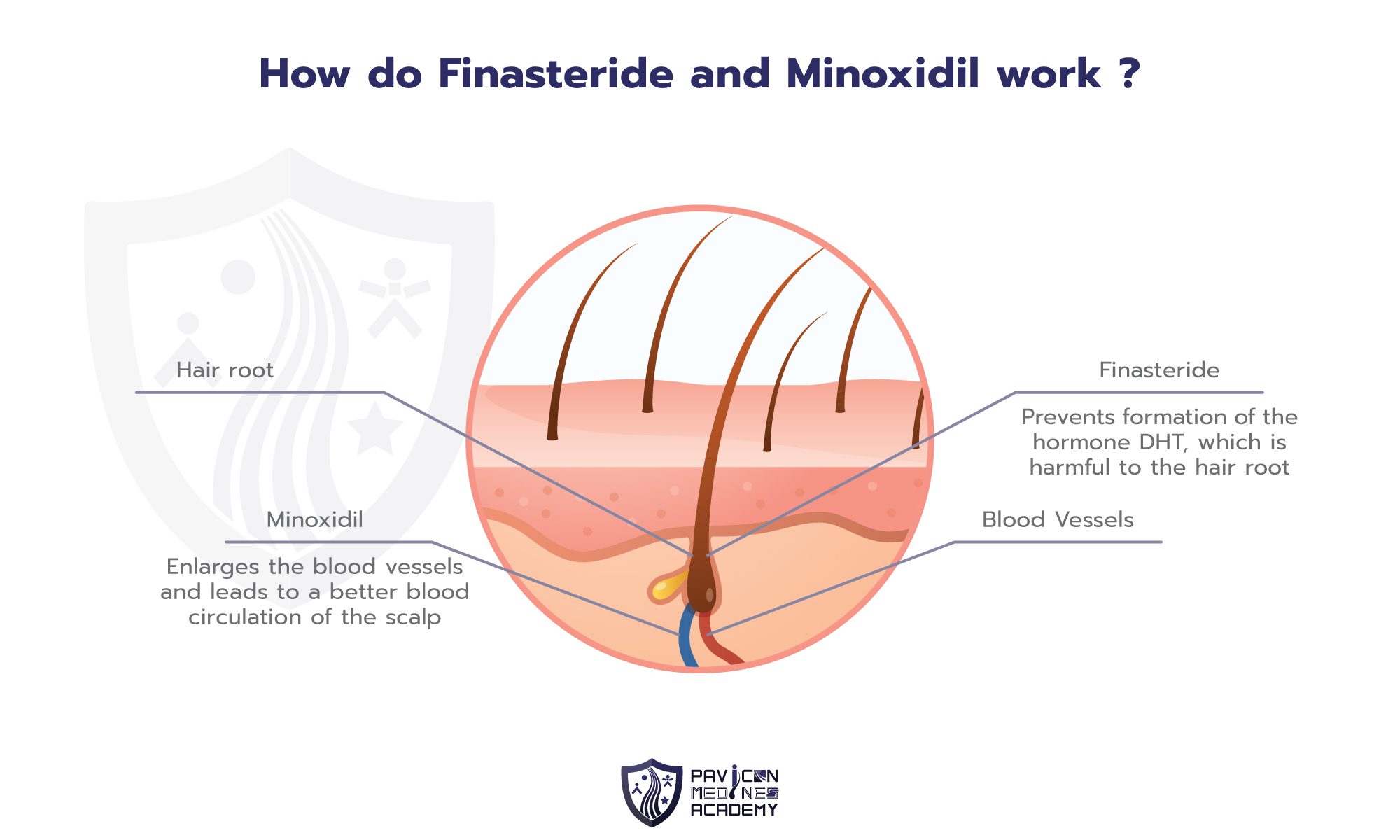 Hair Transplantation For Women Pavicon Mediness Center 3313