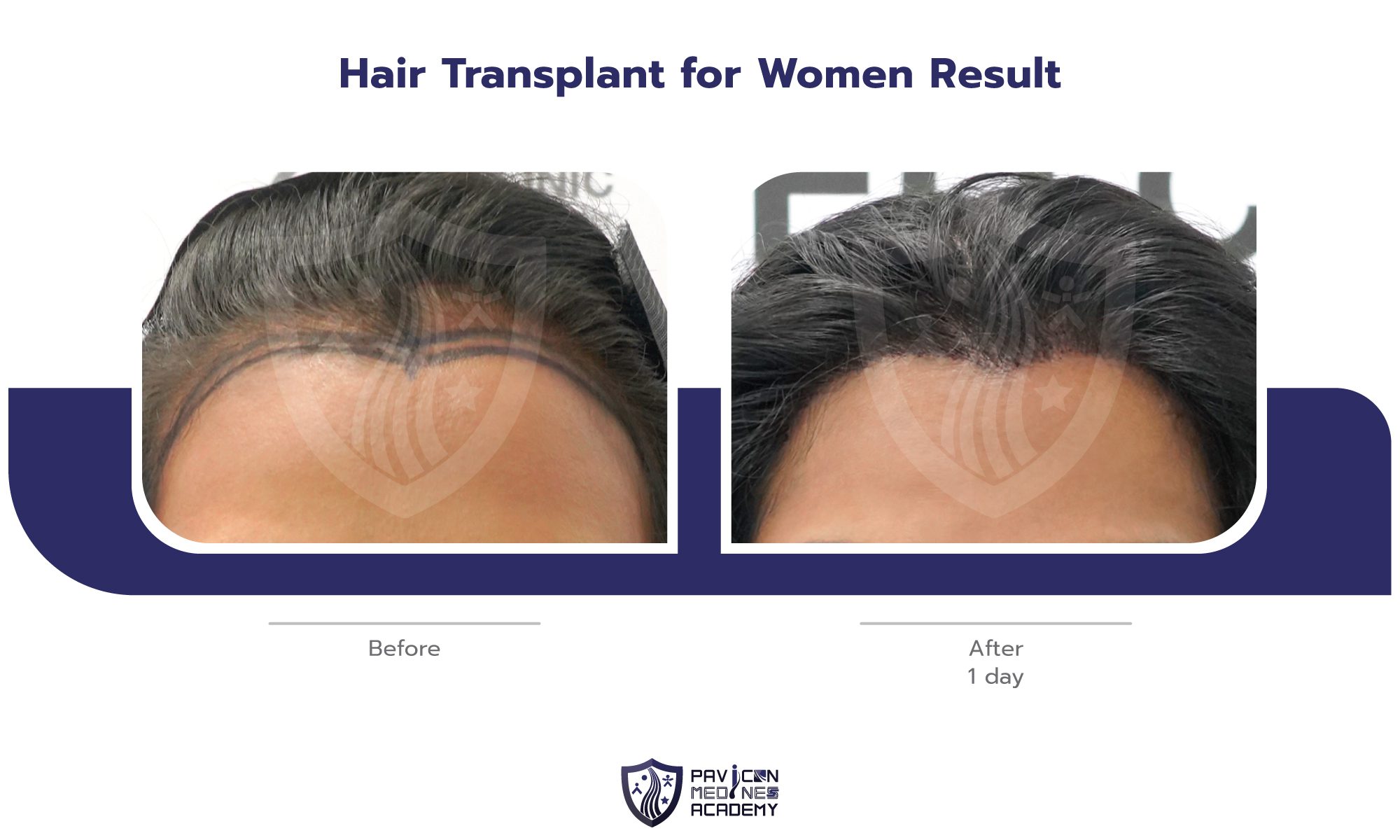 Hair-Transplant-in-WOMAN-EN-07