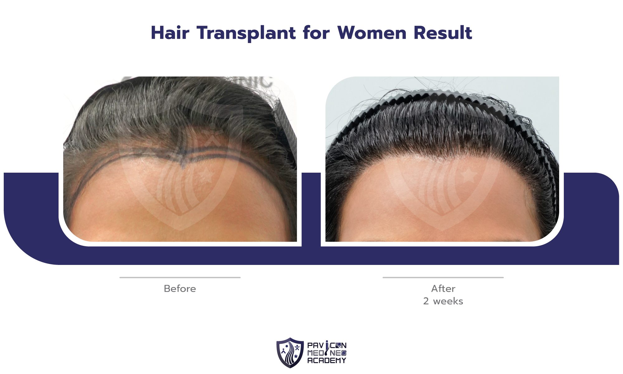 Hair-Transplant-in-WOMAN-EN-08