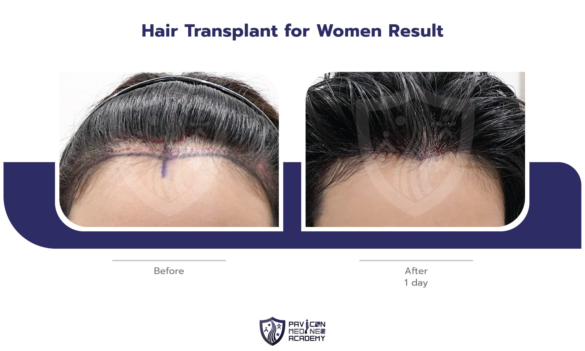 Hair-Transplant-in-WOMAN-EN-09