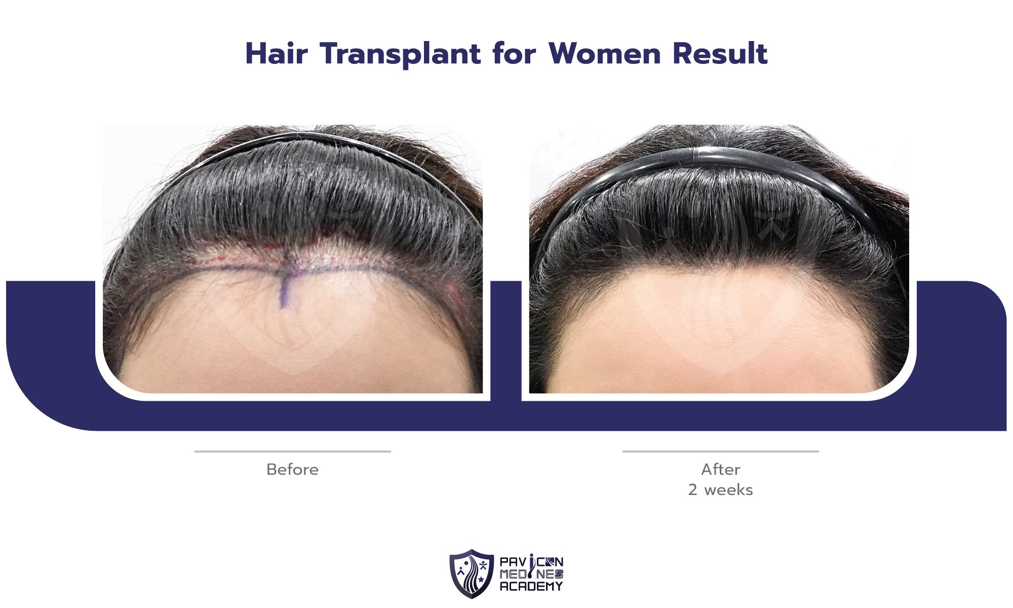 Hair-Transplant-in-WOMAN-EN-10