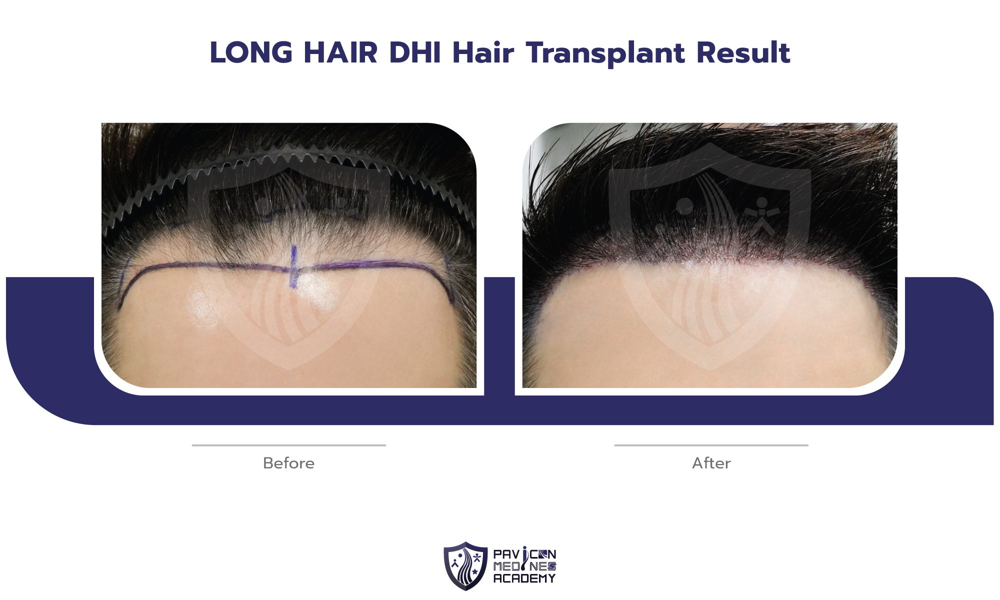 LH-Hair-Transplant-EN-03