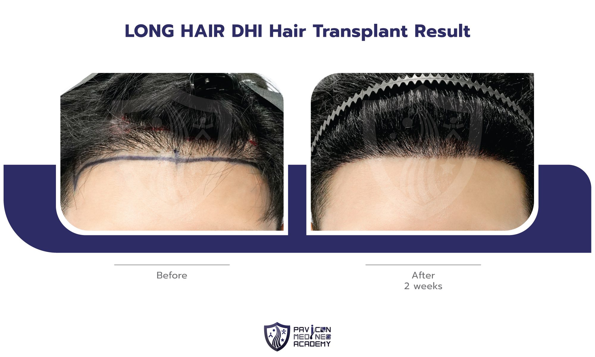 LH-Hair-Transplant-EN-05