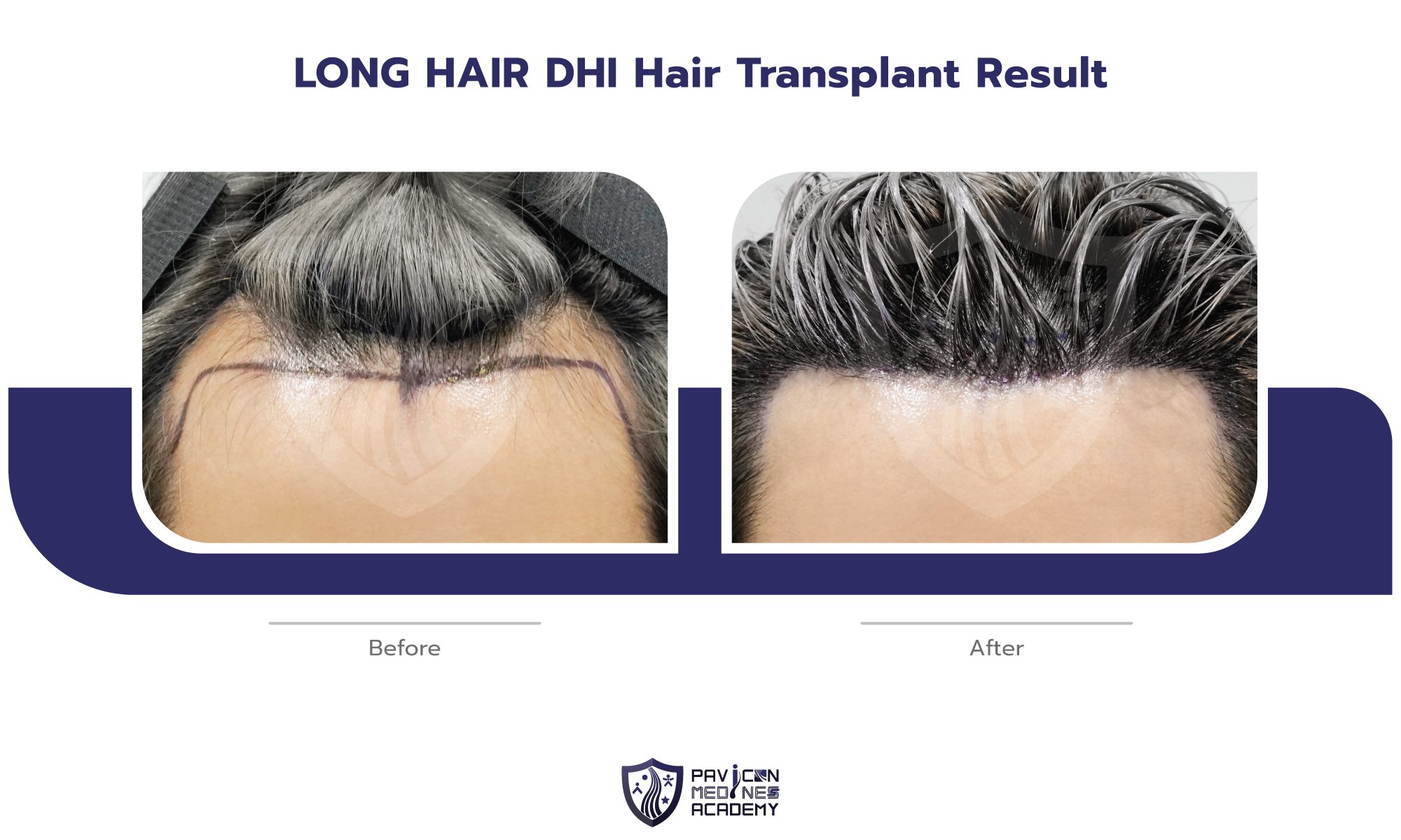 LH-Hair-Transplant-EN-06