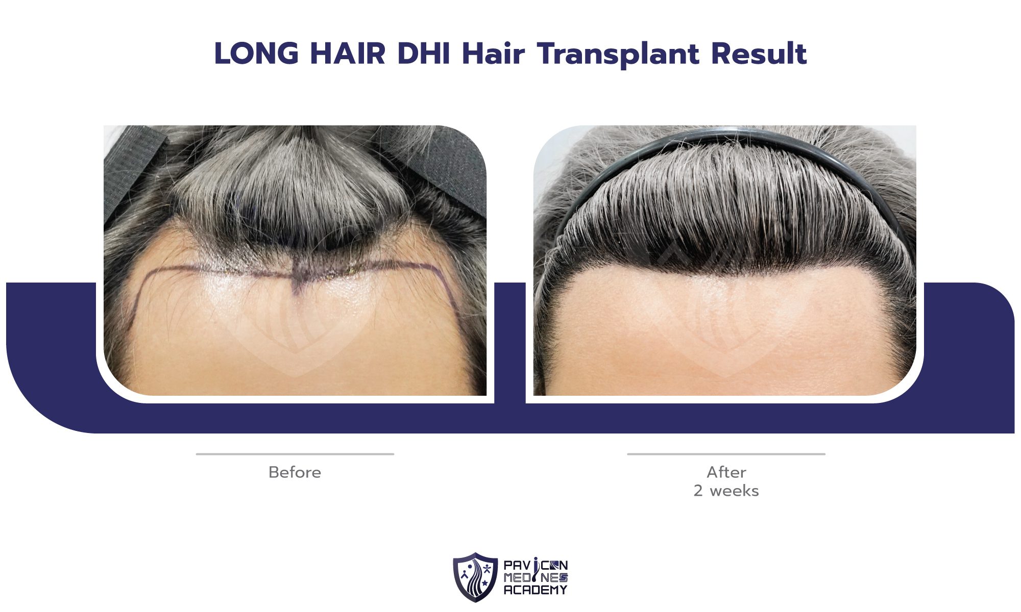 LH-Hair-Transplant-EN-07