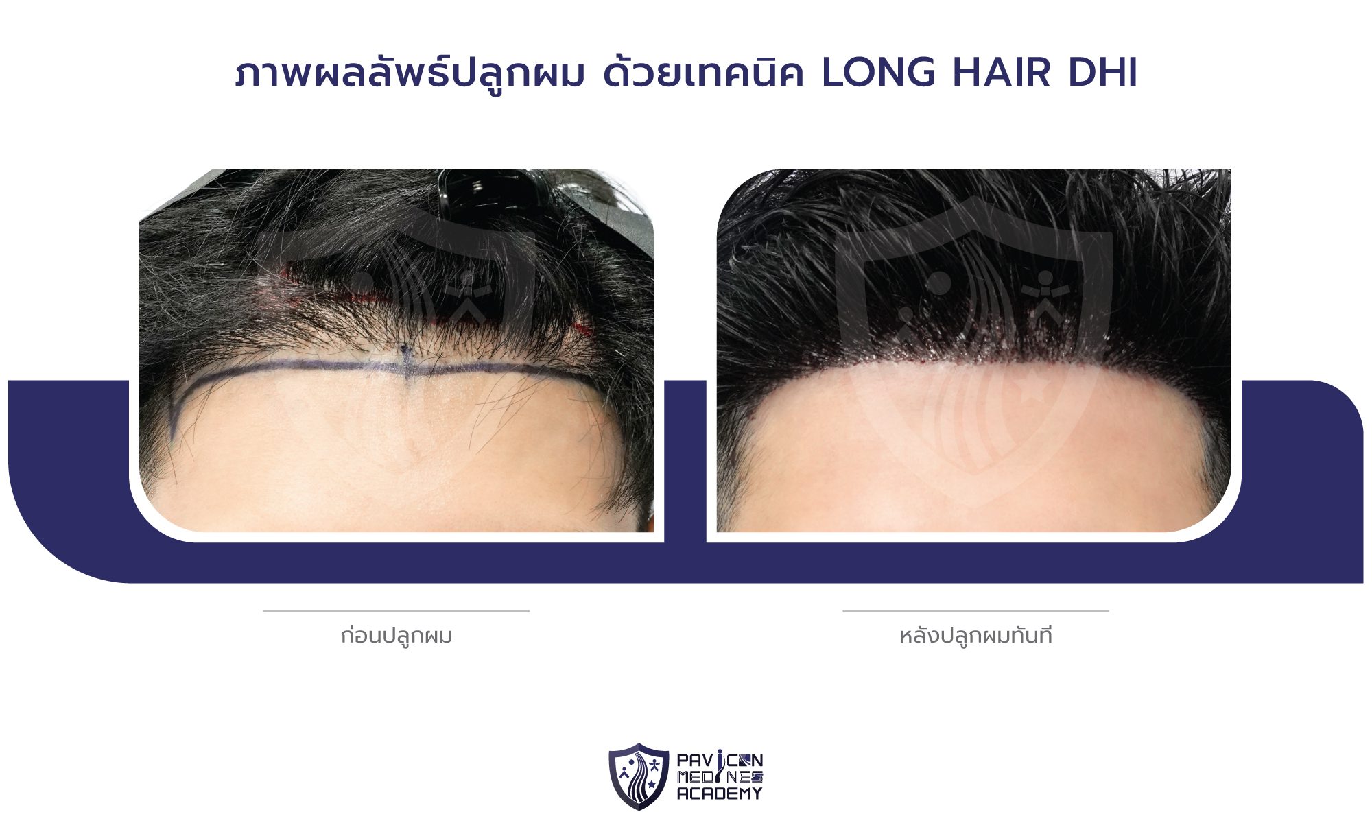 LH-Hair-Transplant-TH-BA-02
