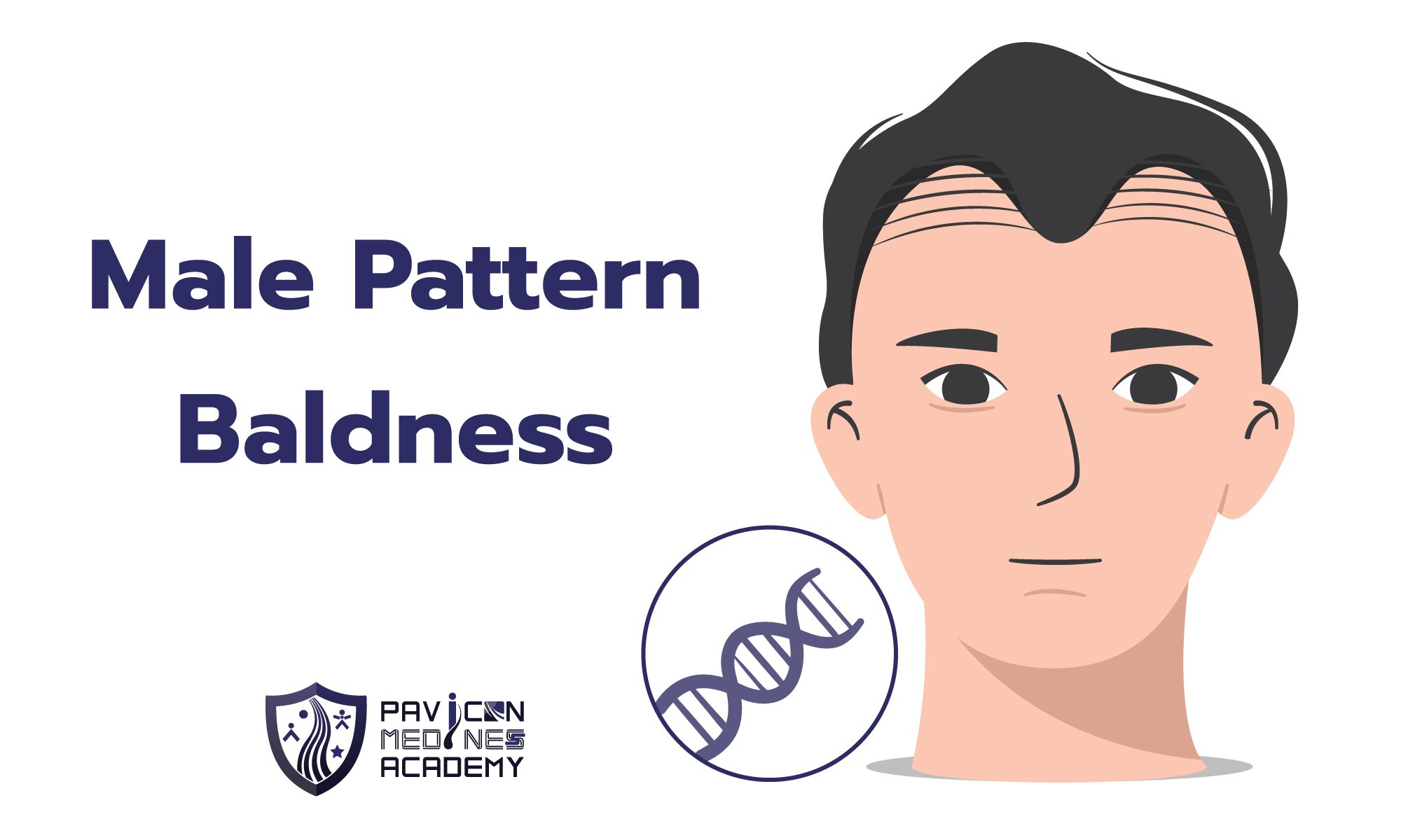 Male Androgenetic Alopecia - Pavicon Mediness Center